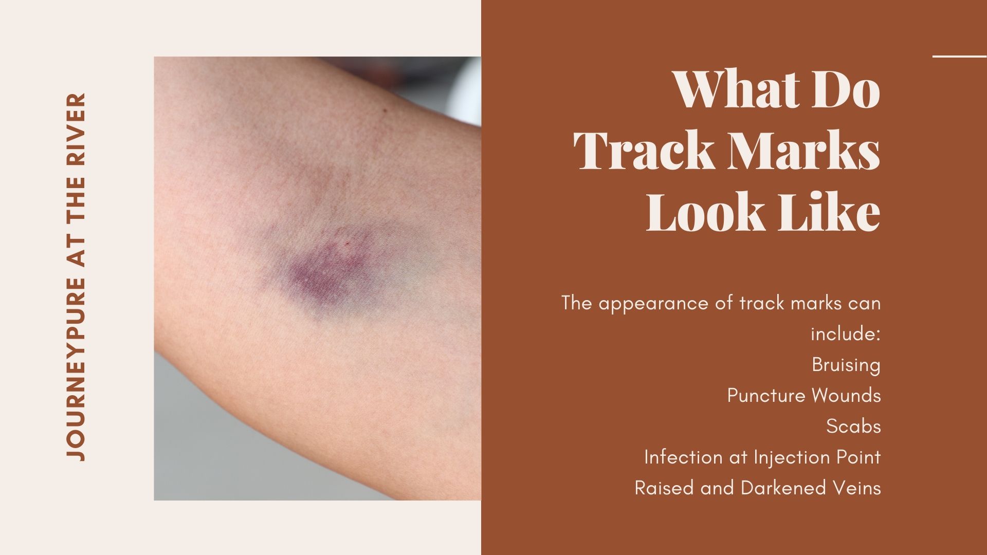 track mark on bruised arm